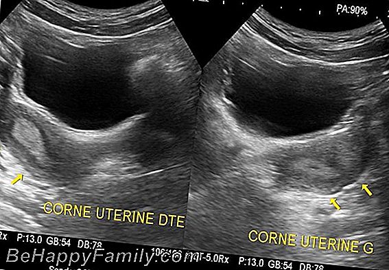 Uterus bicorne: Kann man schwanger werden?