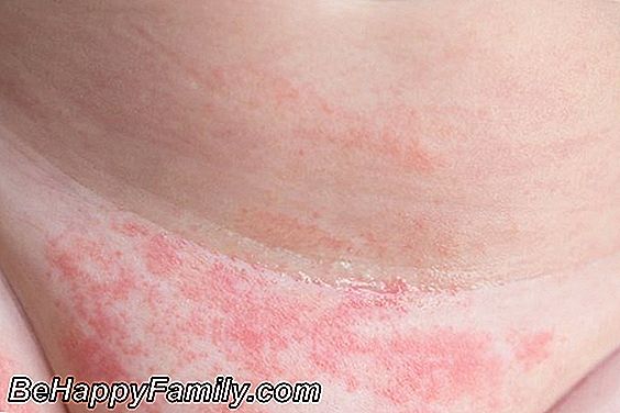 Cómo proteger al niño de la dermatitis