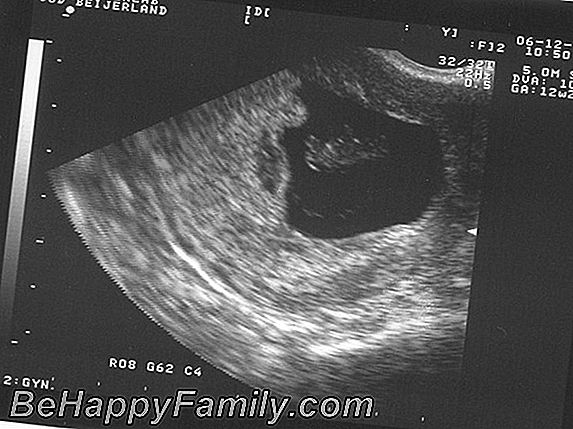 Fibromen naar de baarmoeder: wat ze zijn en hoe ze worden behandeld